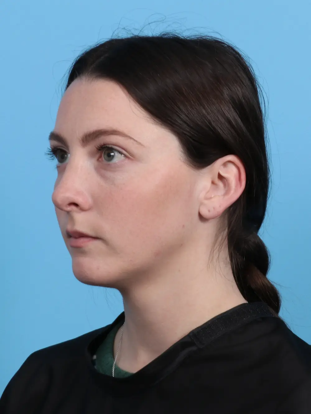 Chin Implant Patient Photo - Case 27550 - after view-1
