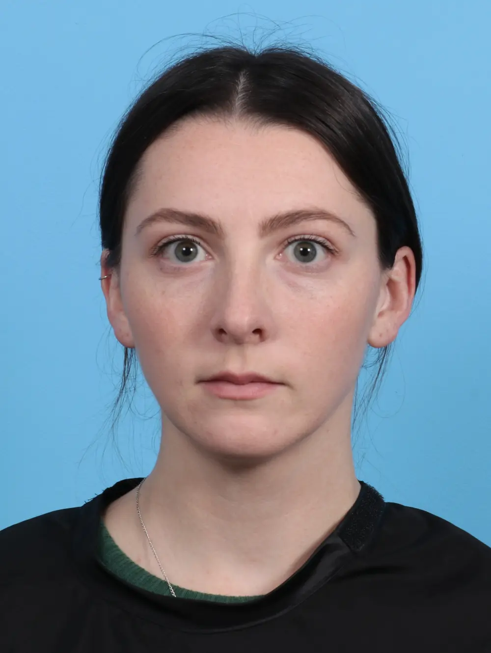 Chin Implant Patient Photo - Case 27550 - after view-2
