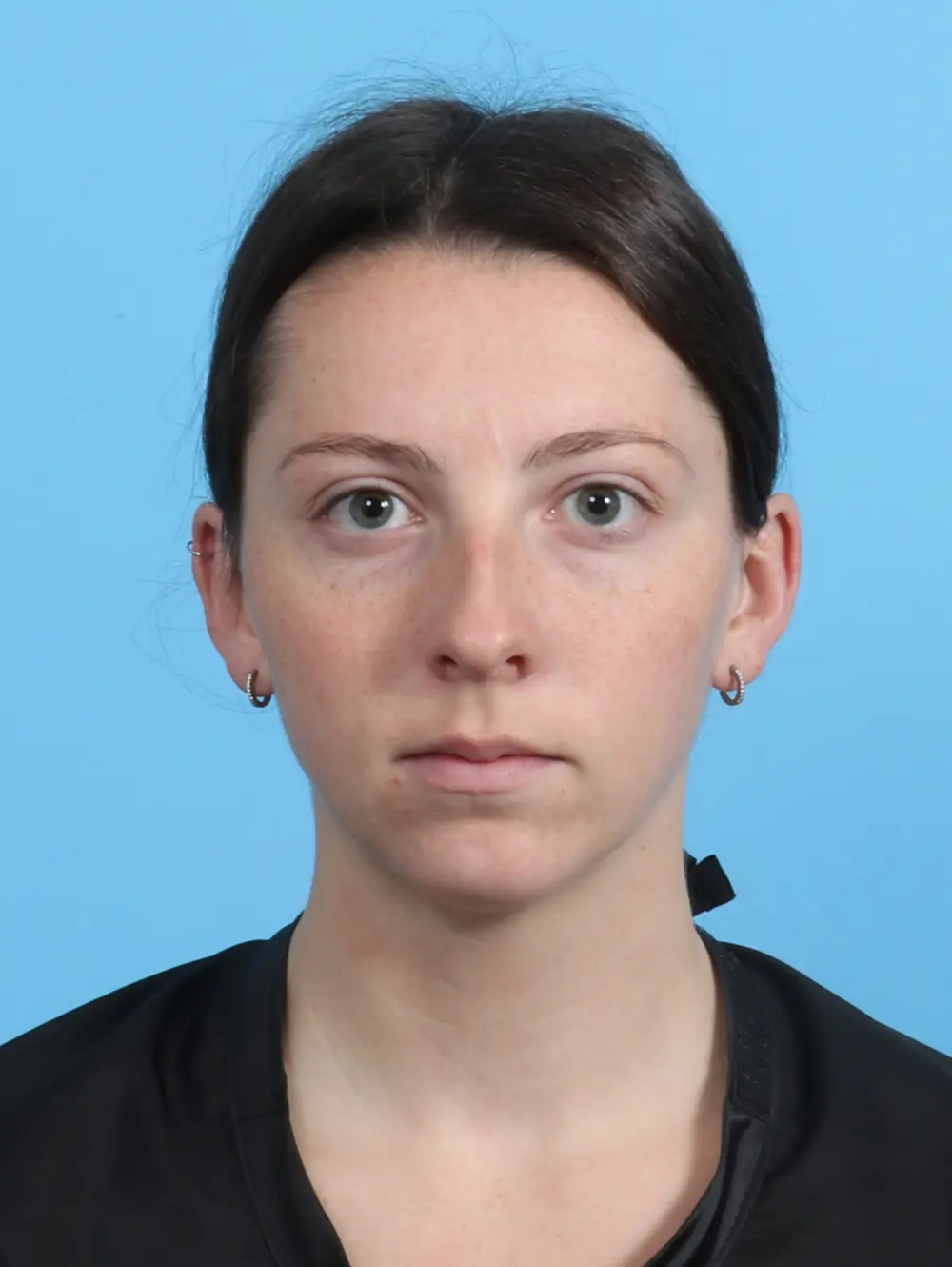 Chin Implant Patient Photo - Case 27550 - before view-2