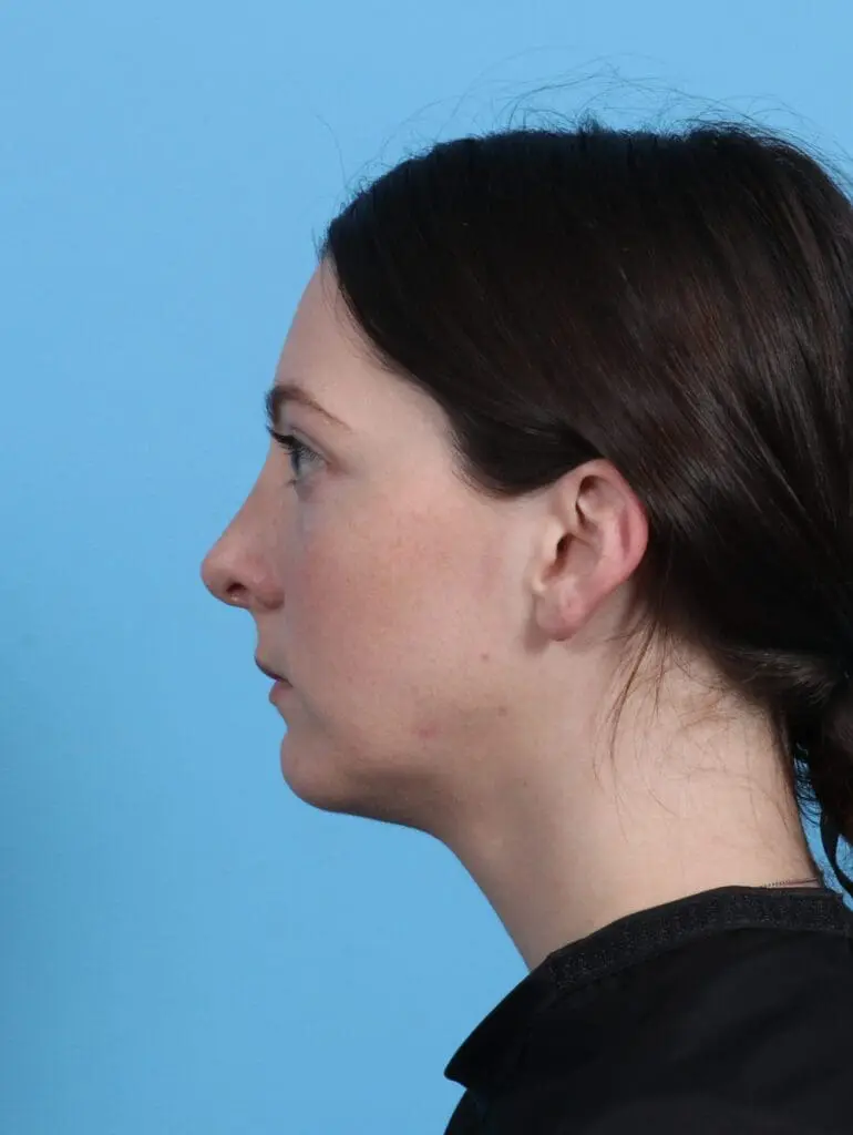 Chin Implant - Case 27550 - After