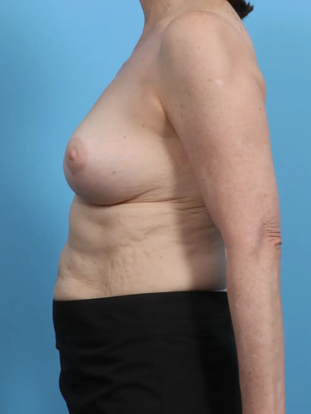 Breast Lift/Reduction w/o Implants Patient Photo - Case 27612 - after view-2