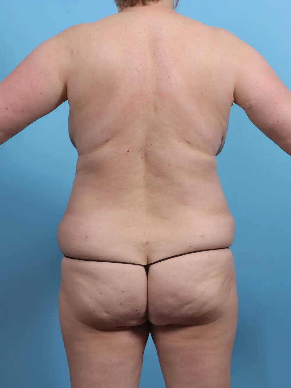 Breast Lift/Reduction w/o Implants Patient Photo - Case 27628 - after view-3