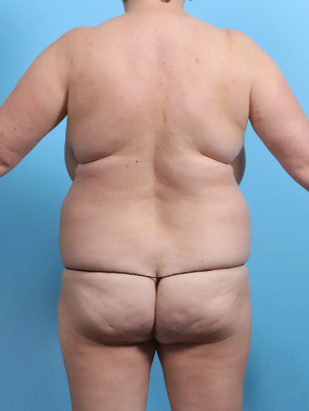 Breast Lift/Reduction w/o Implants Patient Photo - Case 27628 - before view-3