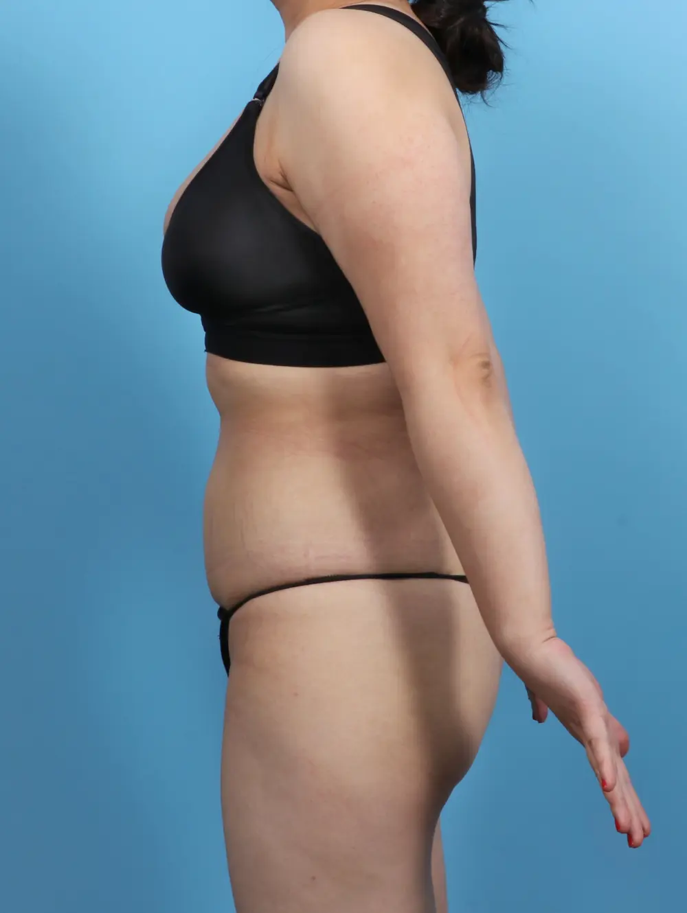 Liposuction Patient Photo - Case 27679 - after view-2
