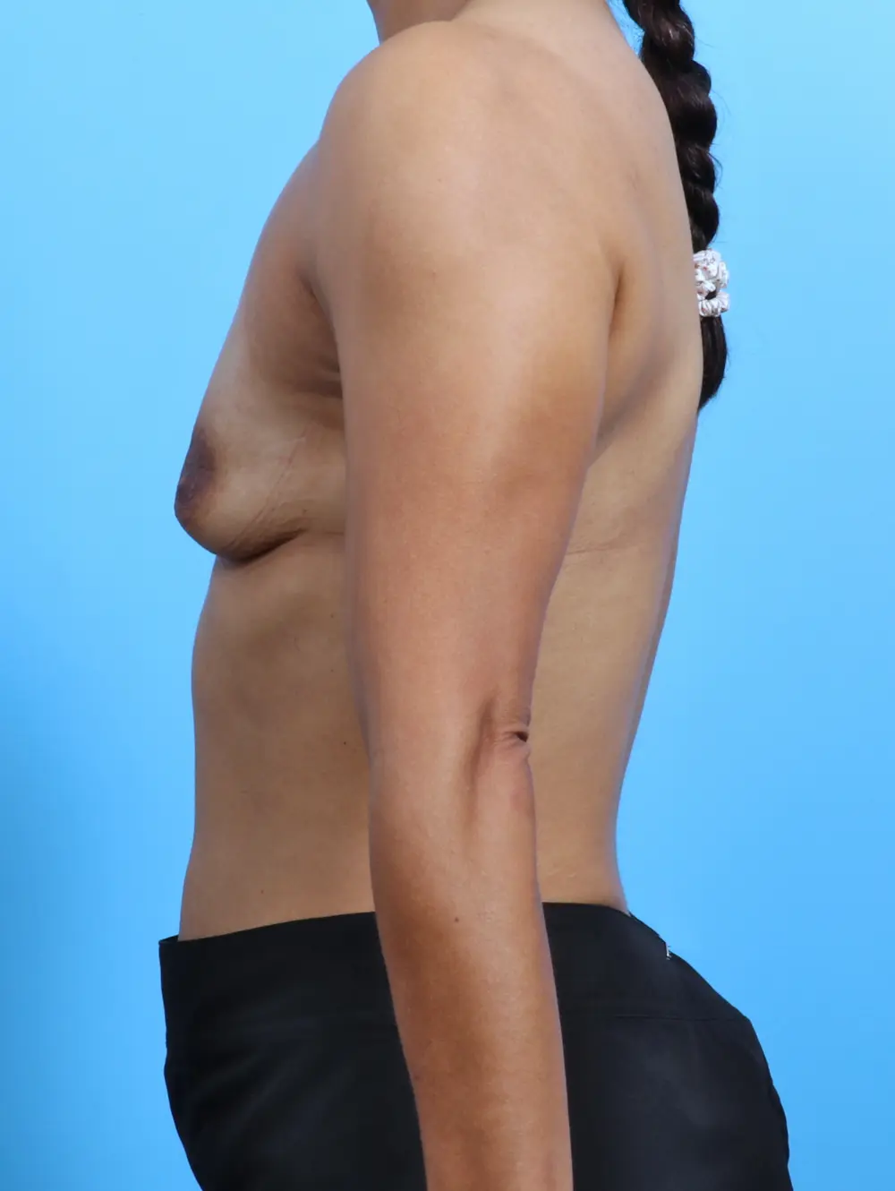 Breast Augmentation Patient Photo - Case 27697 - before view-2