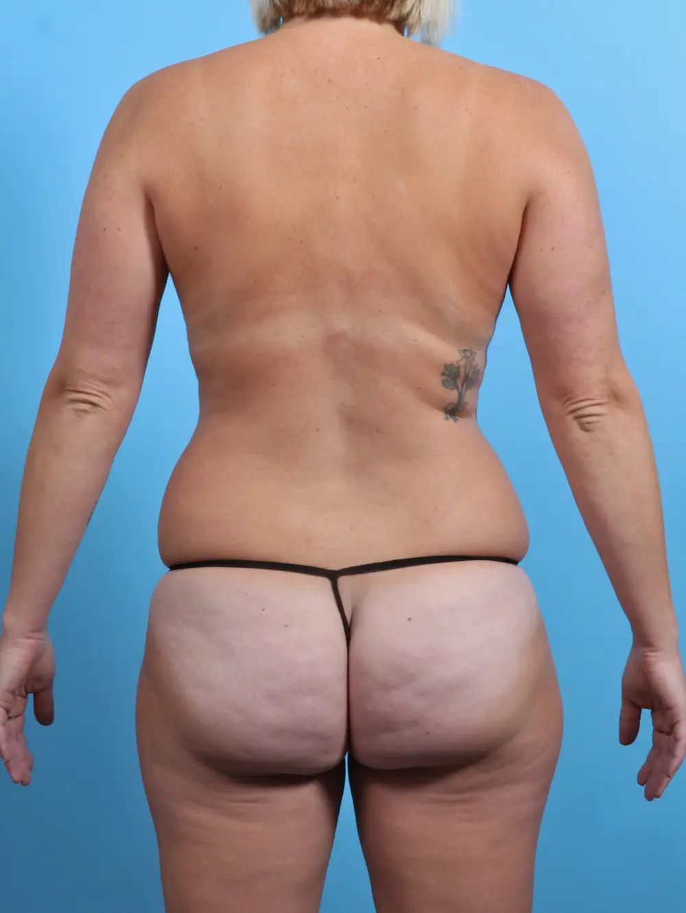 Mommy Makeover Patient Photo - Case 27714 - before view-3