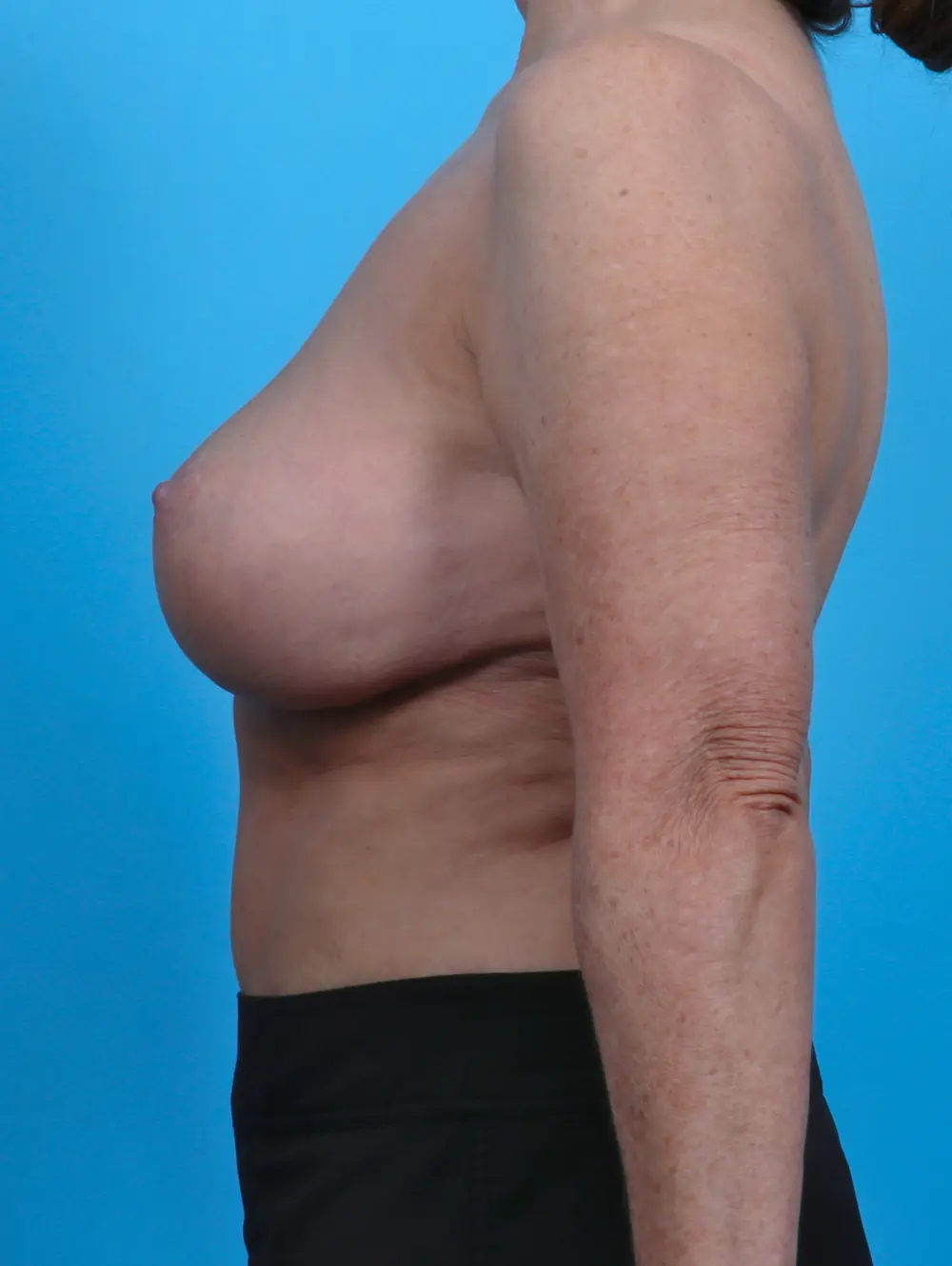 Breast Lift/Reduction w/o Implants Patient Photo - Case 27732 - after view-2