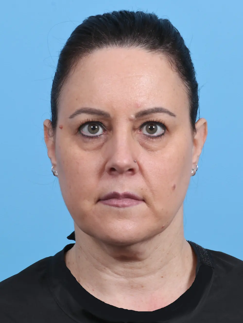 Before Eyelid Surgery