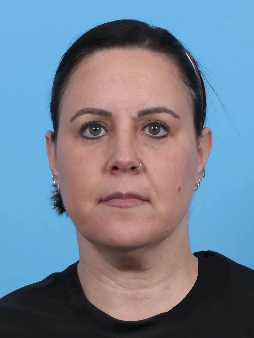 After Eyelid Surgery