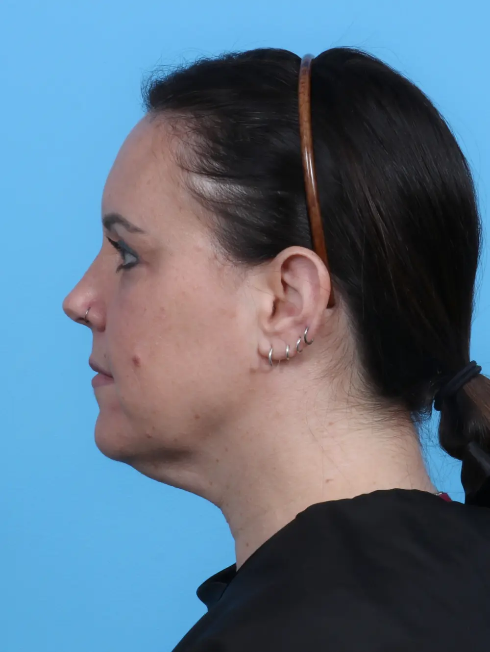 Eyelid Surgery Patient Photo - Case 27740 - after view-2