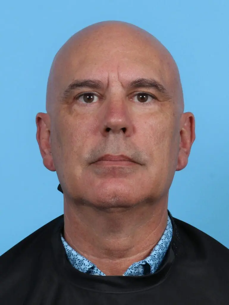 Eyelid Surgery - Case 27777 - After