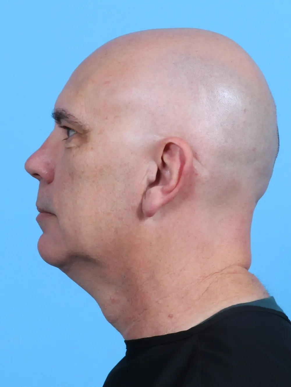 Eyelid Surgery Patient Photo - Case 27777 - before view-2