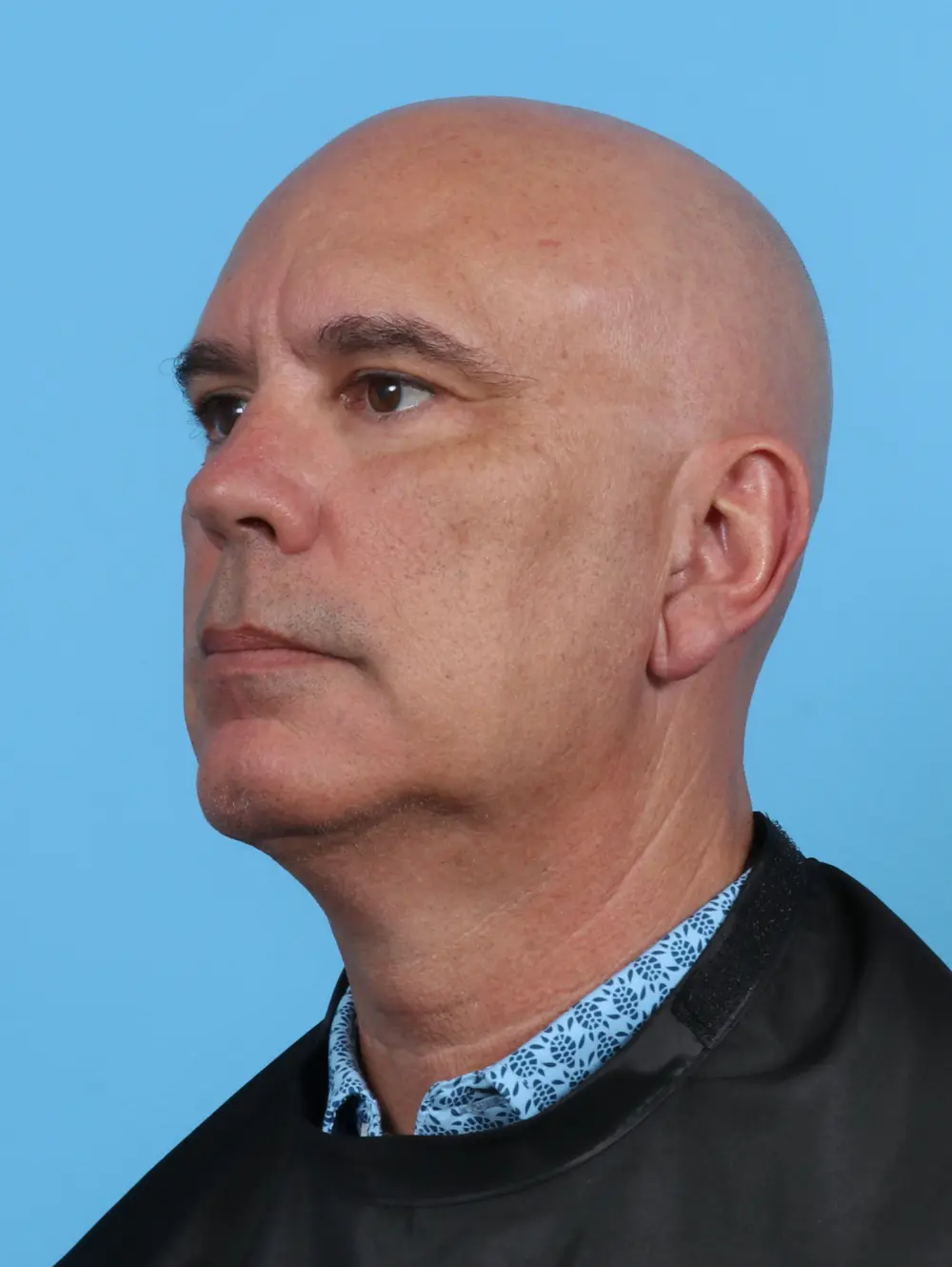 Eyelid Surgery Patient Photo - Case 27777 - after view-1