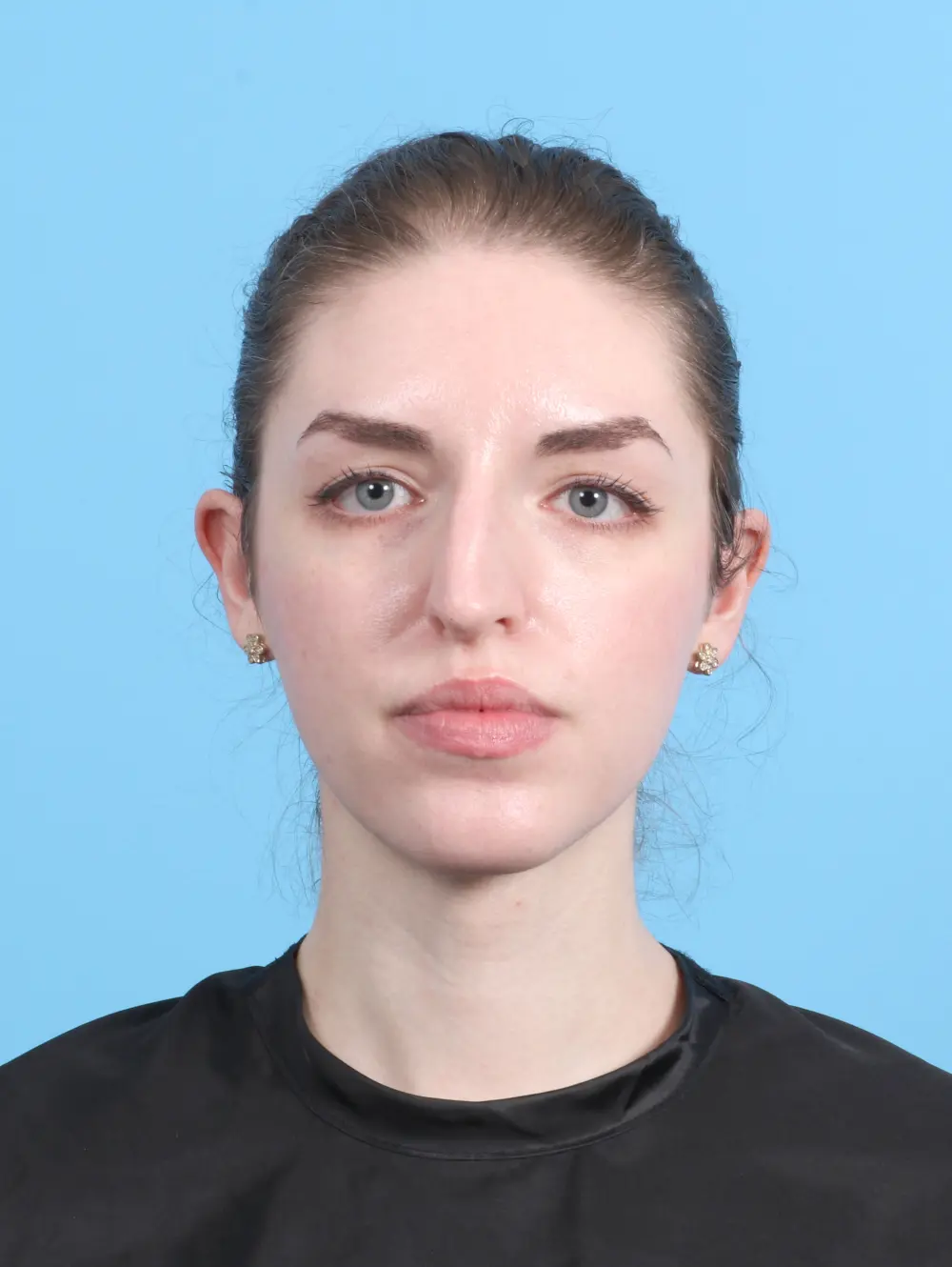 Rhinoplasty Patient Photo - Case 27689 - before view-2