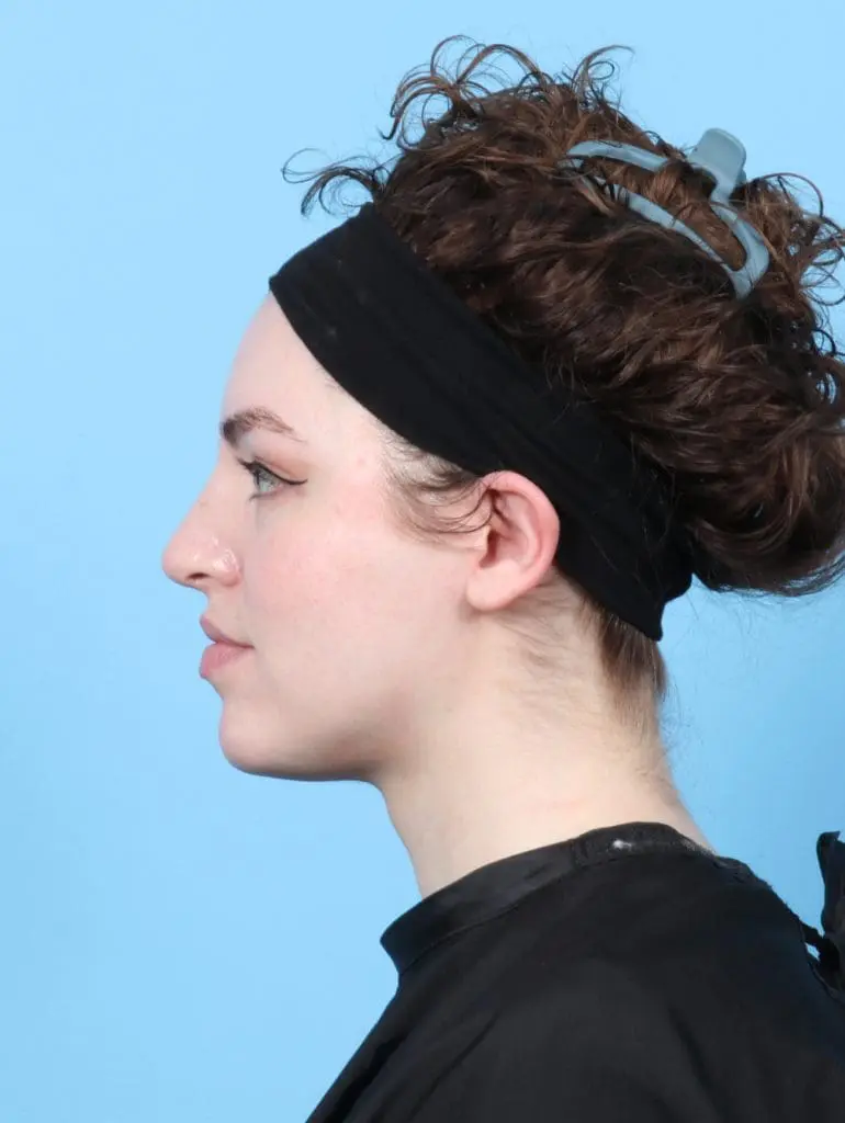 Rhinoplasty - Case 27689 - After