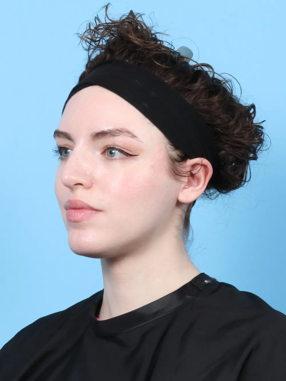 Rhinoplasty Patient Photo - Case 27689 - after view-1