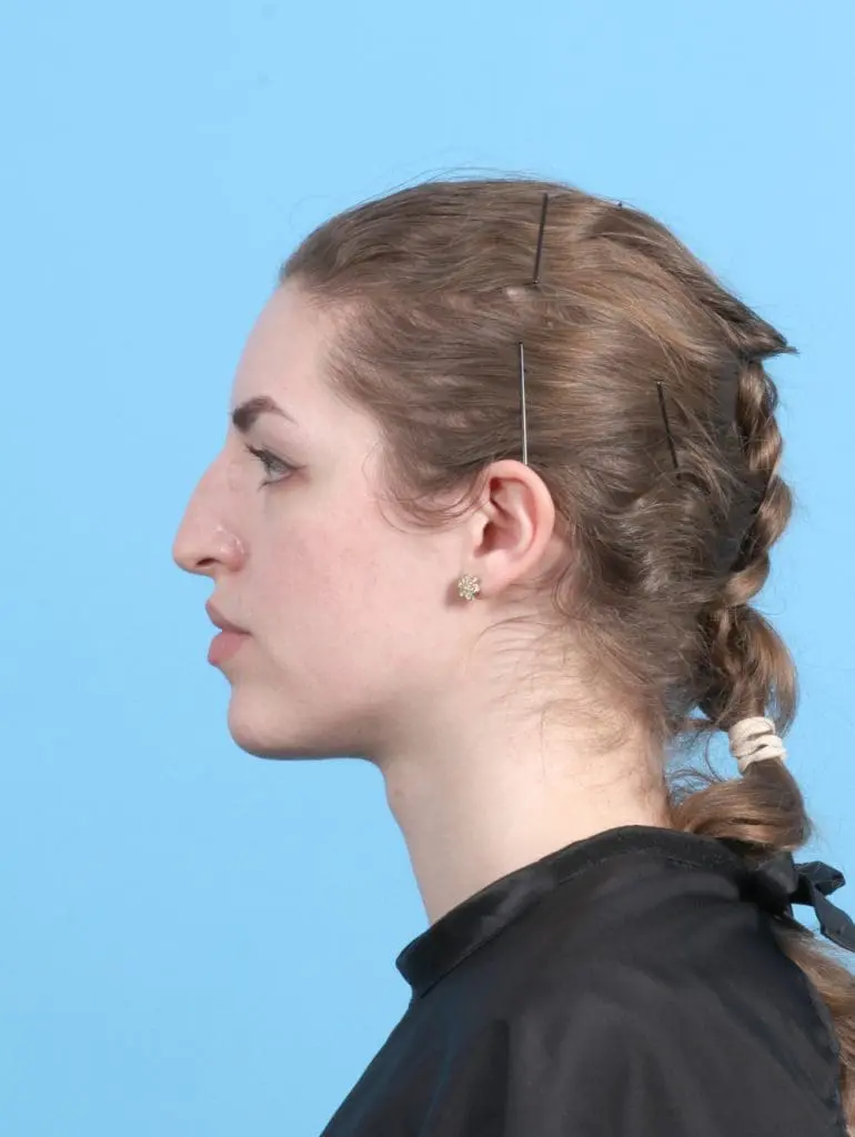 Rhinoplasty - Case 27689 - Before