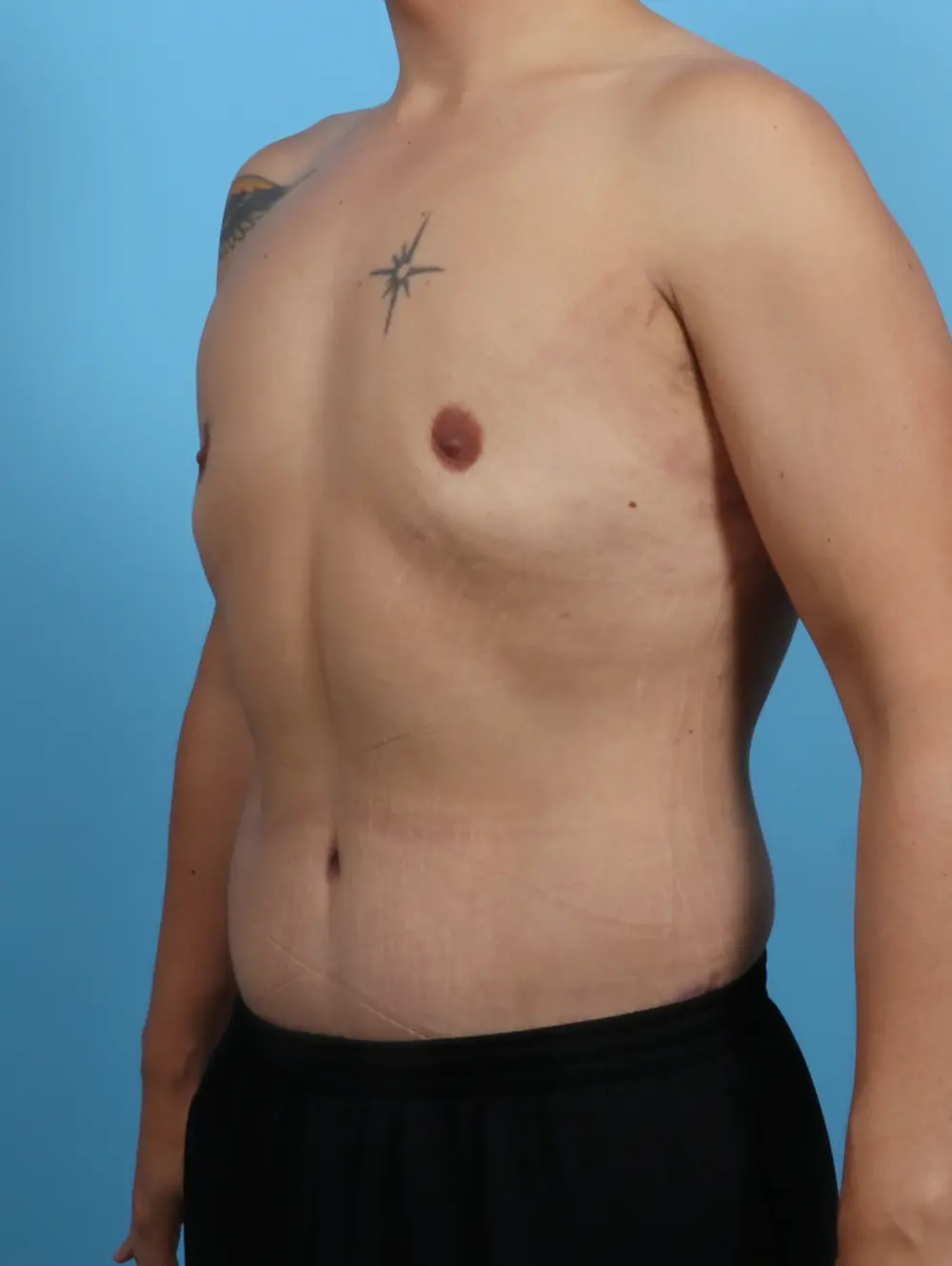Gynecomastia Patient Photo - Case 27889 - after view-1