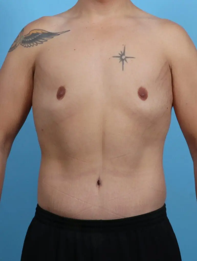 Gynecomastia - Case 27889 - After