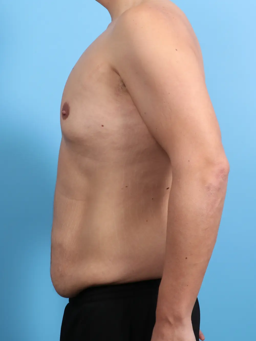 Gynecomastia Patient Photo - Case 27889 - before view-2