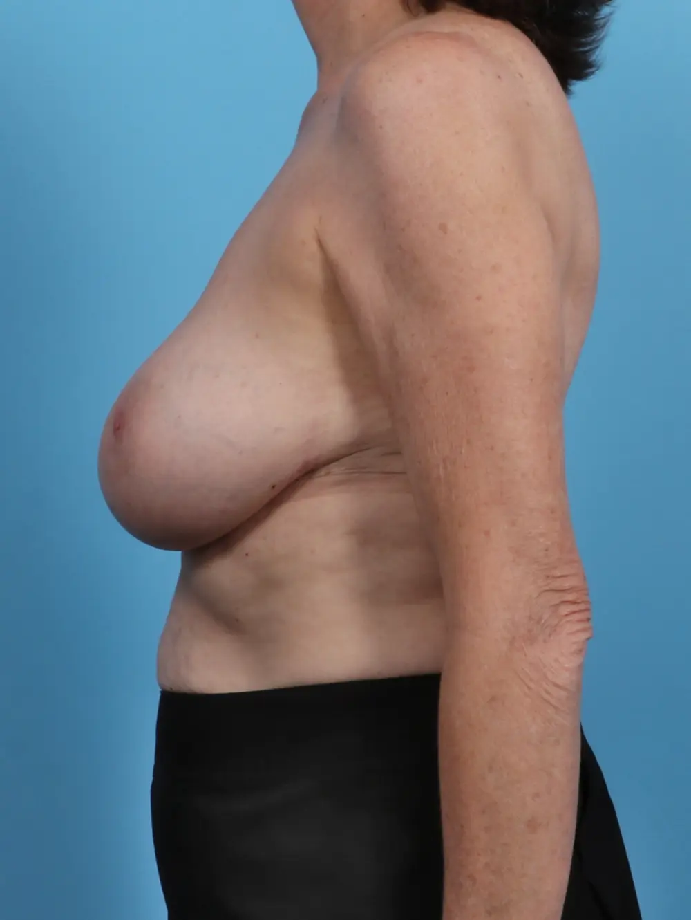 Breast Implant Revision Patient Photo - Case 27899 - after view-2