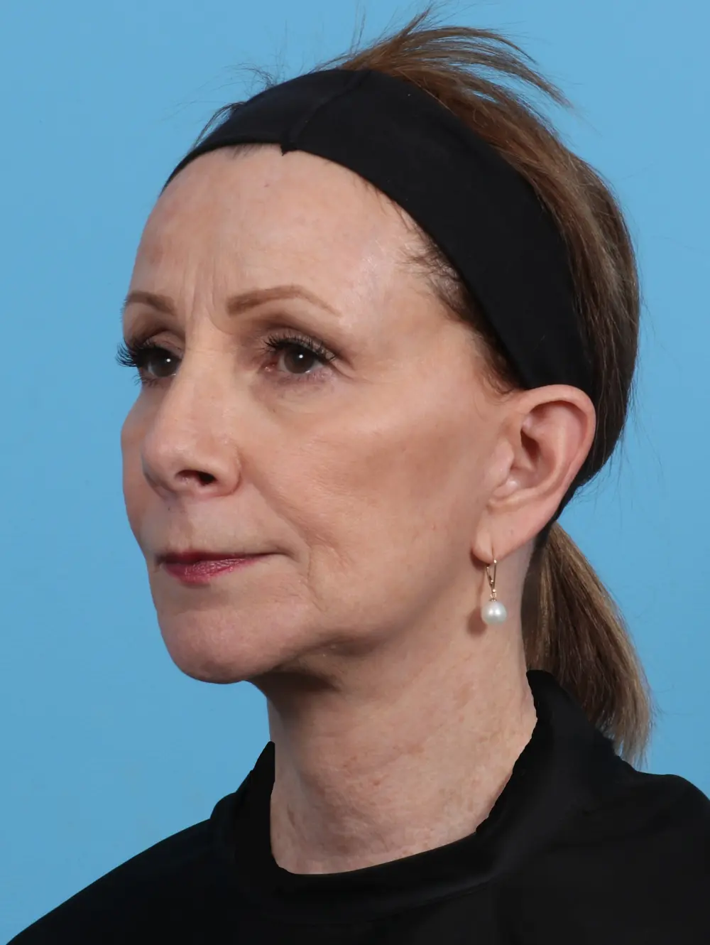 Facelift / Neck Lift Patient Photo - Case 27907 - after view-1