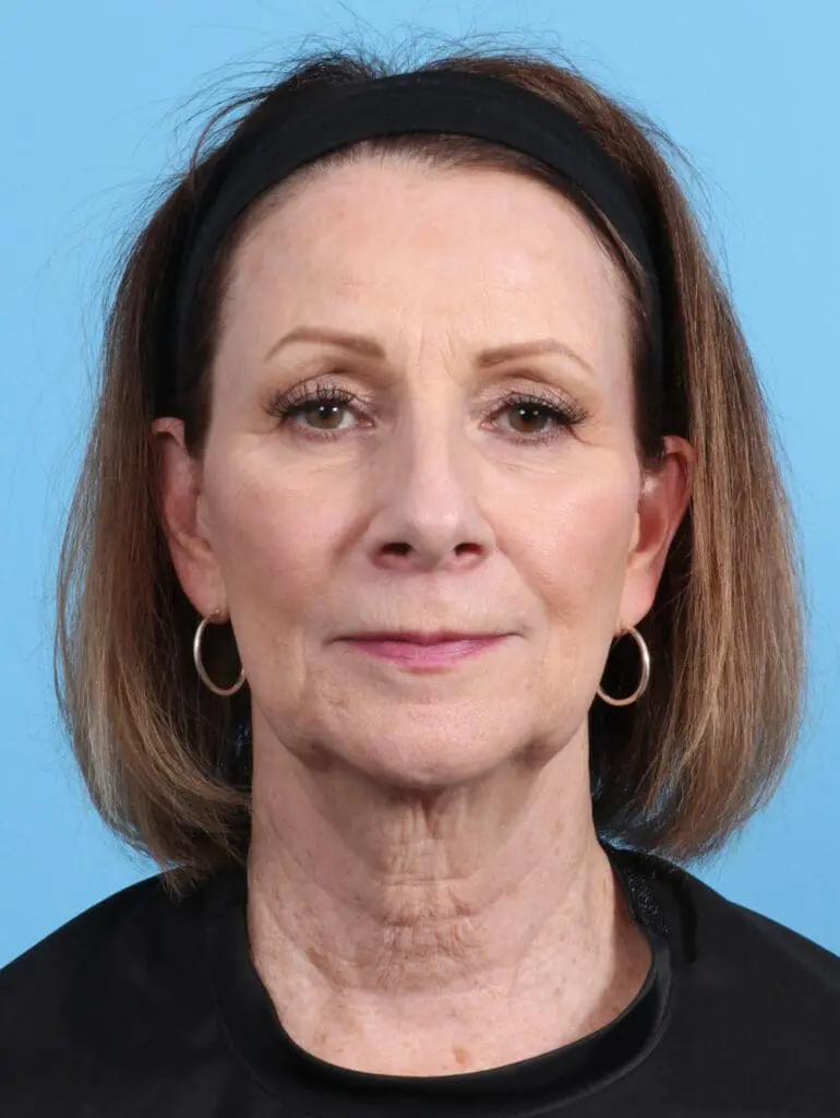 Facelift / Neck Lift - Case 27907 - Before