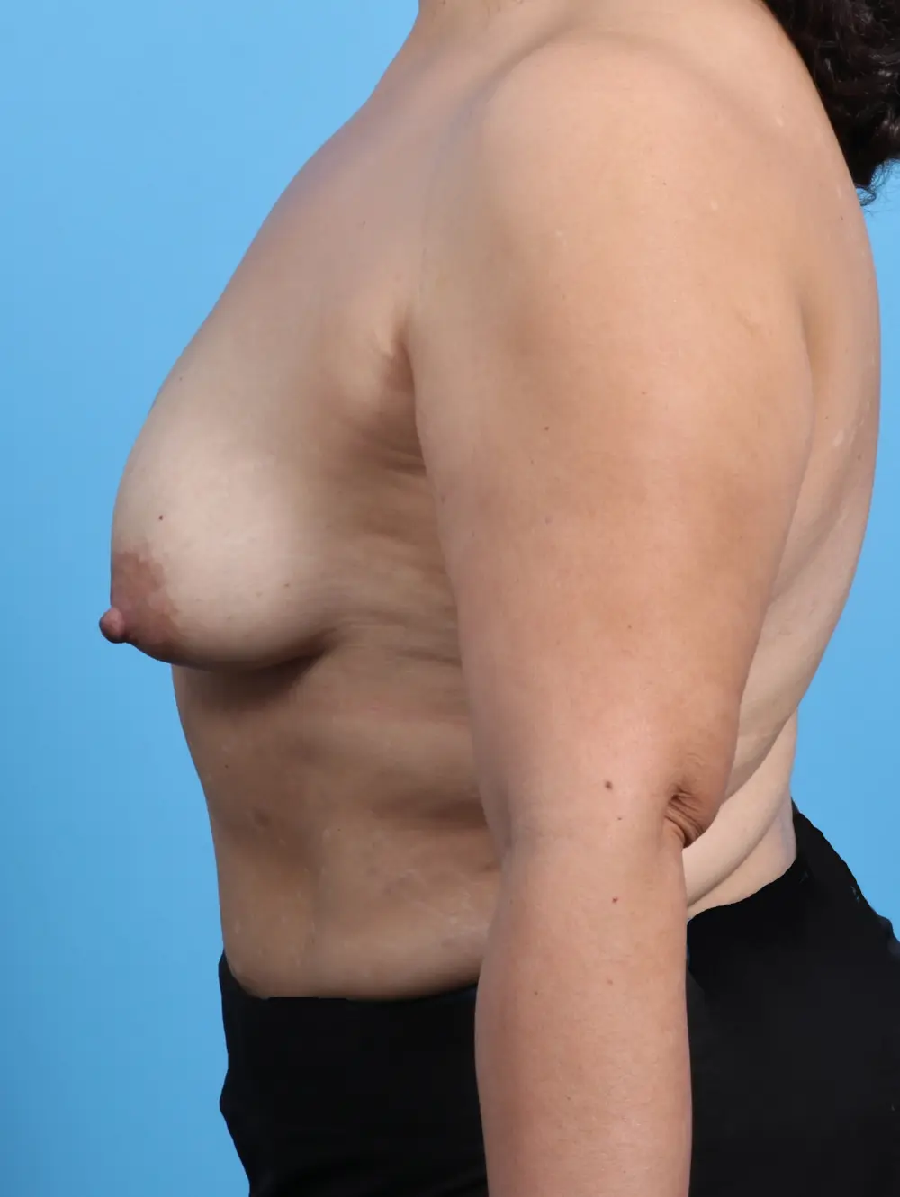 Breast Lift/Reduction with Implants Patient Photo - Case 27923 - before view-2