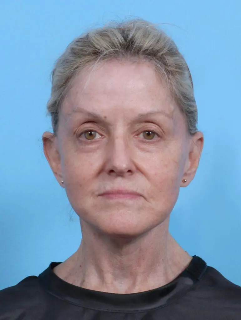 Facelift / Neck Lift - Case 27941 - After
