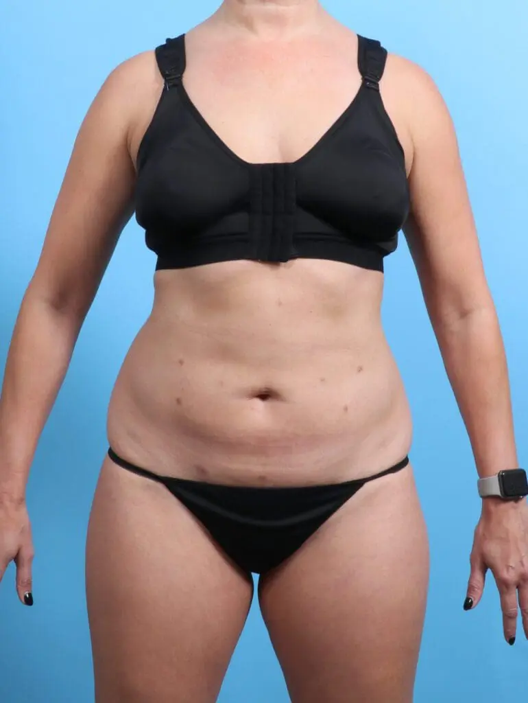 Tummy Tuck - Case 27957 - Before