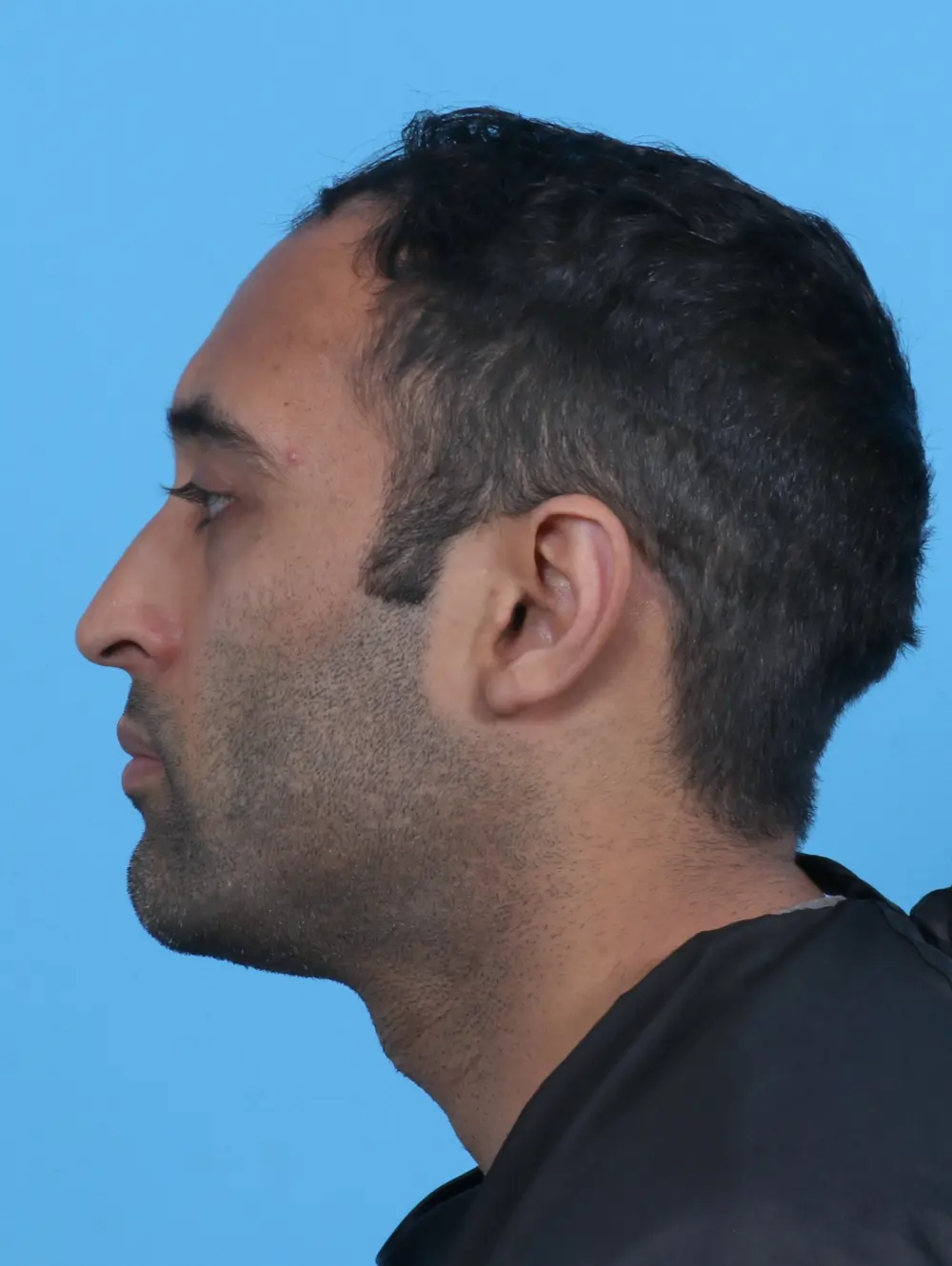 Eyelid Surgery Patient Photo - Case 27965 - after view-2