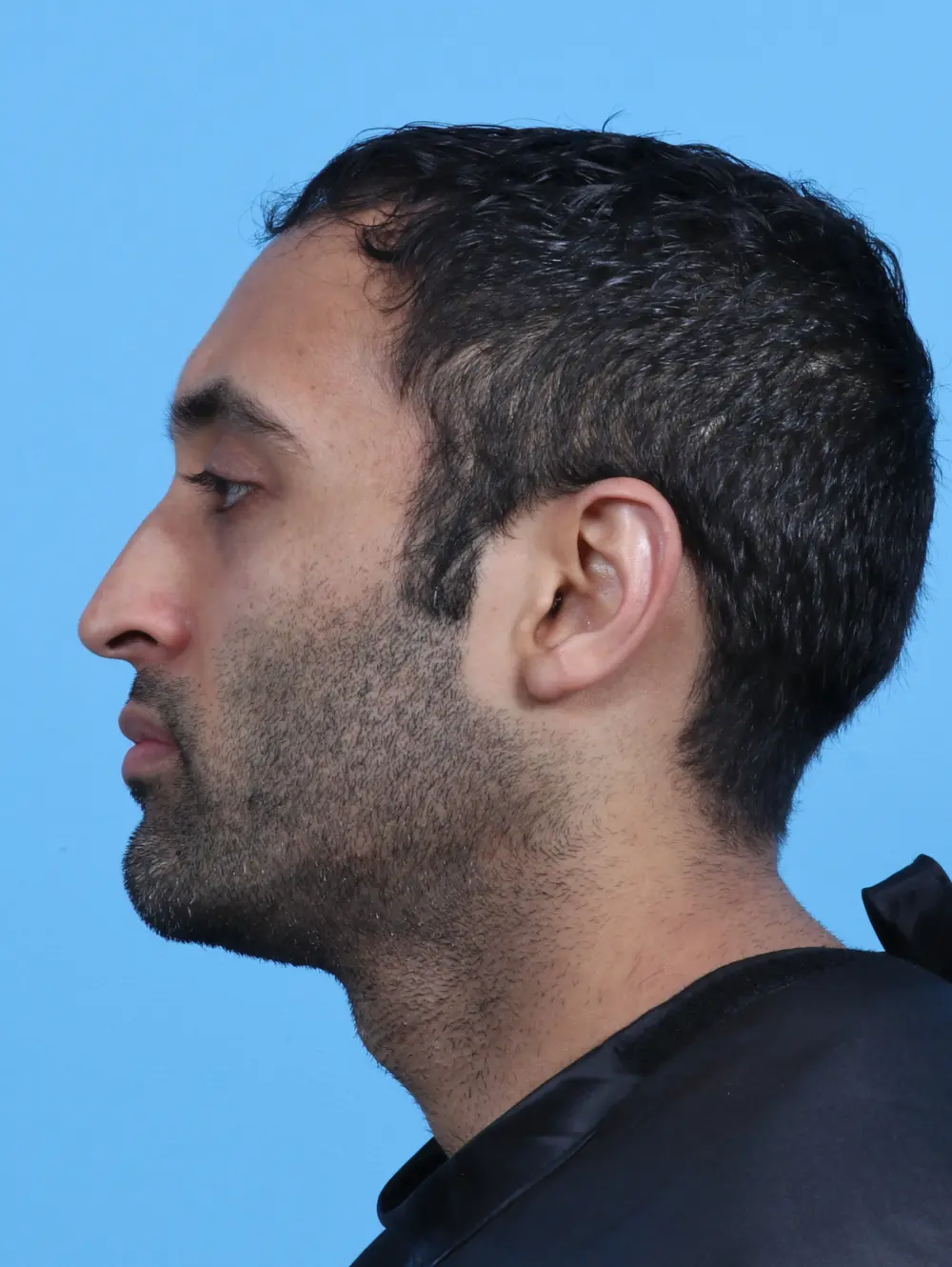 Eyelid Surgery Patient Photo - Case 27965 - before view-2