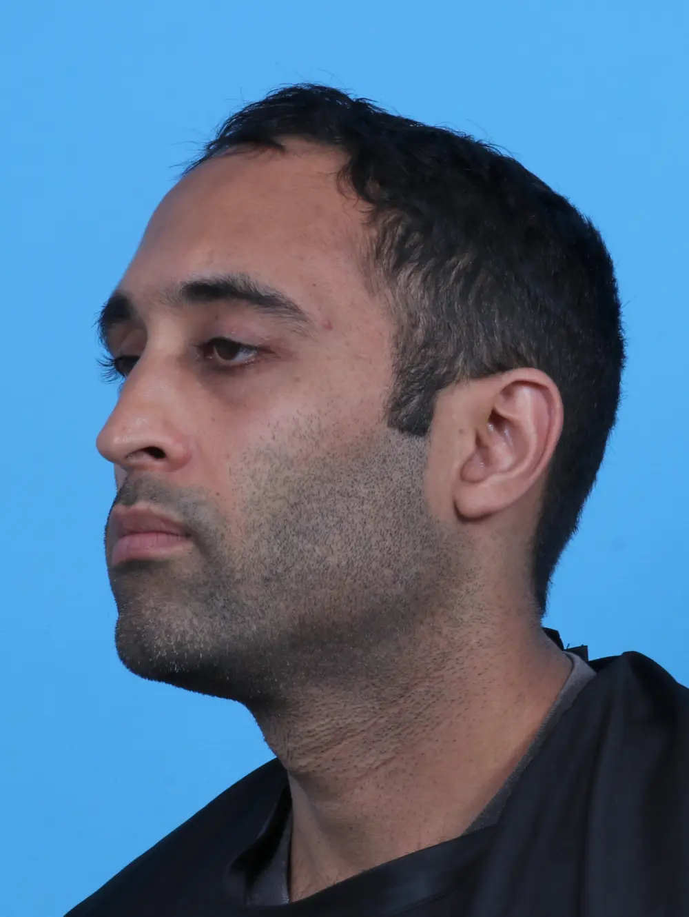 Eyelid Surgery Patient Photo - Case 27965 - after view-1