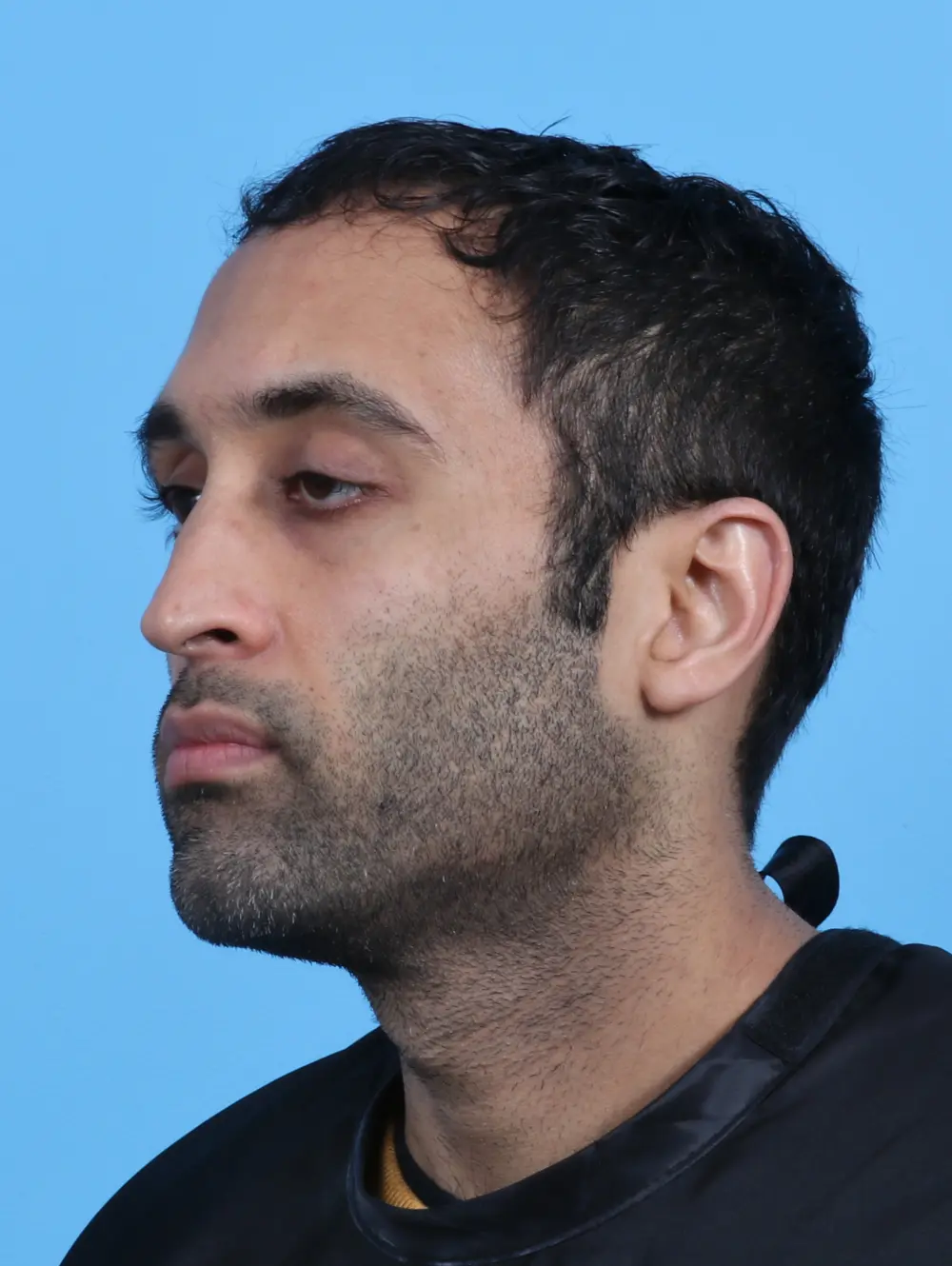 Eyelid Surgery Patient Photo - Case 27965 - before view-1