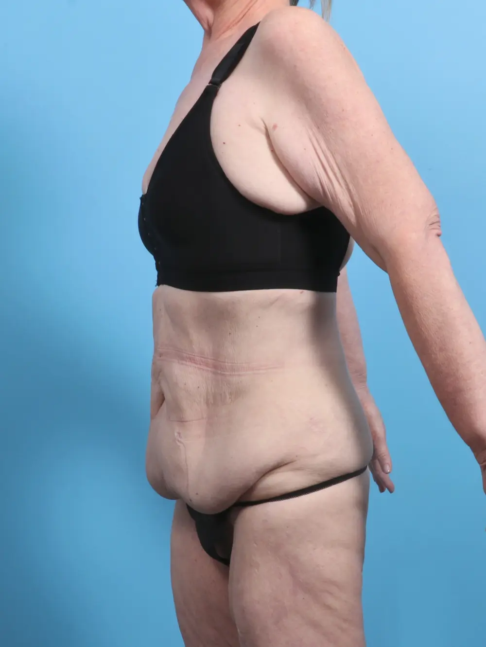 Tummy Tuck Patient Photo - Case 27973 - before view-1