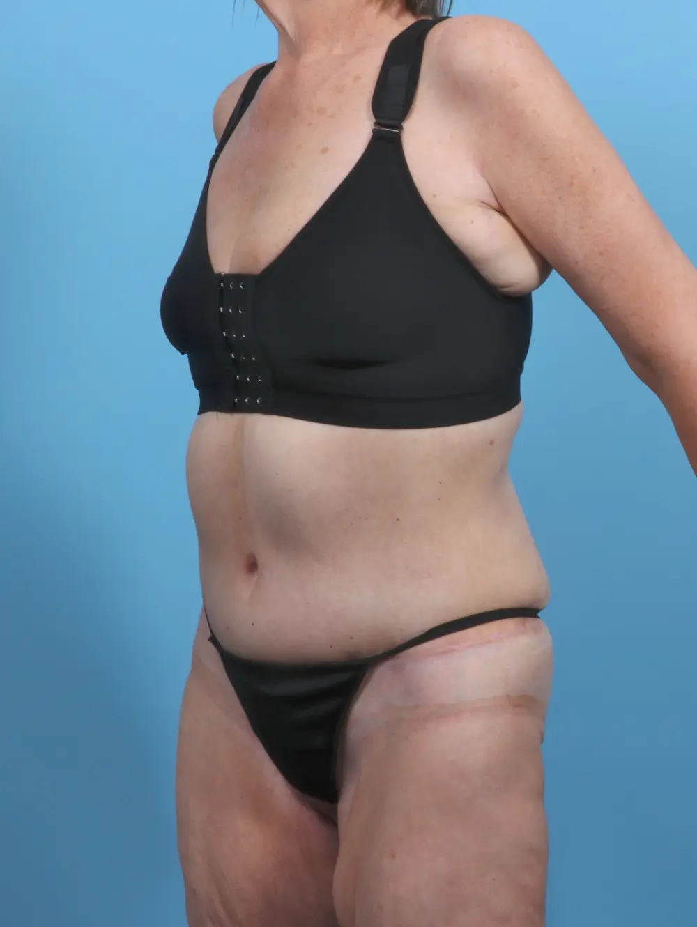 Tummy Tuck Patient Photo - Case 27973 - after view-1