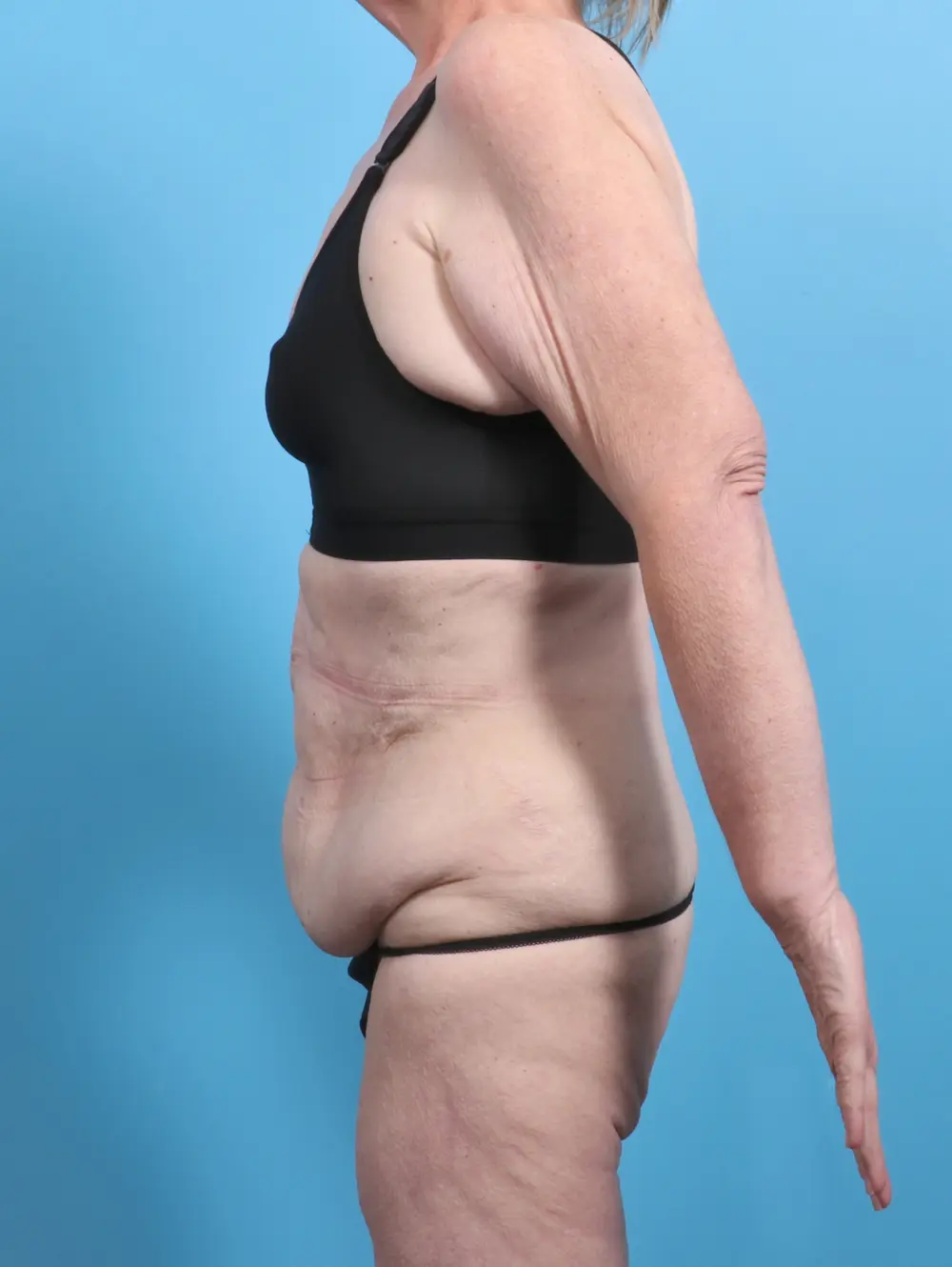 Tummy Tuck Patient Photo - Case 27973 - before view-2