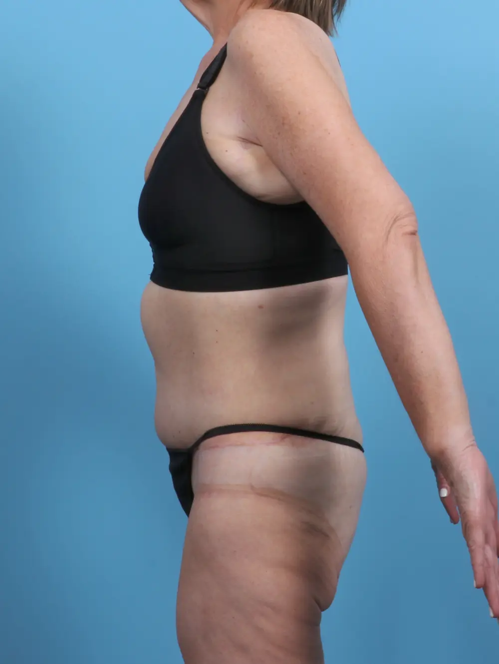 Tummy Tuck Patient Photo - Case 27973 - after view-2