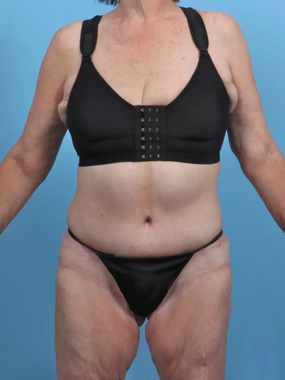 Tummy Tuck Patient Photo - Case 27973 - after view