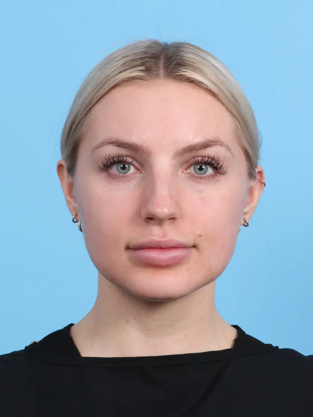 Rhinoplasty Patient Photo - Case 27984 - before view-2