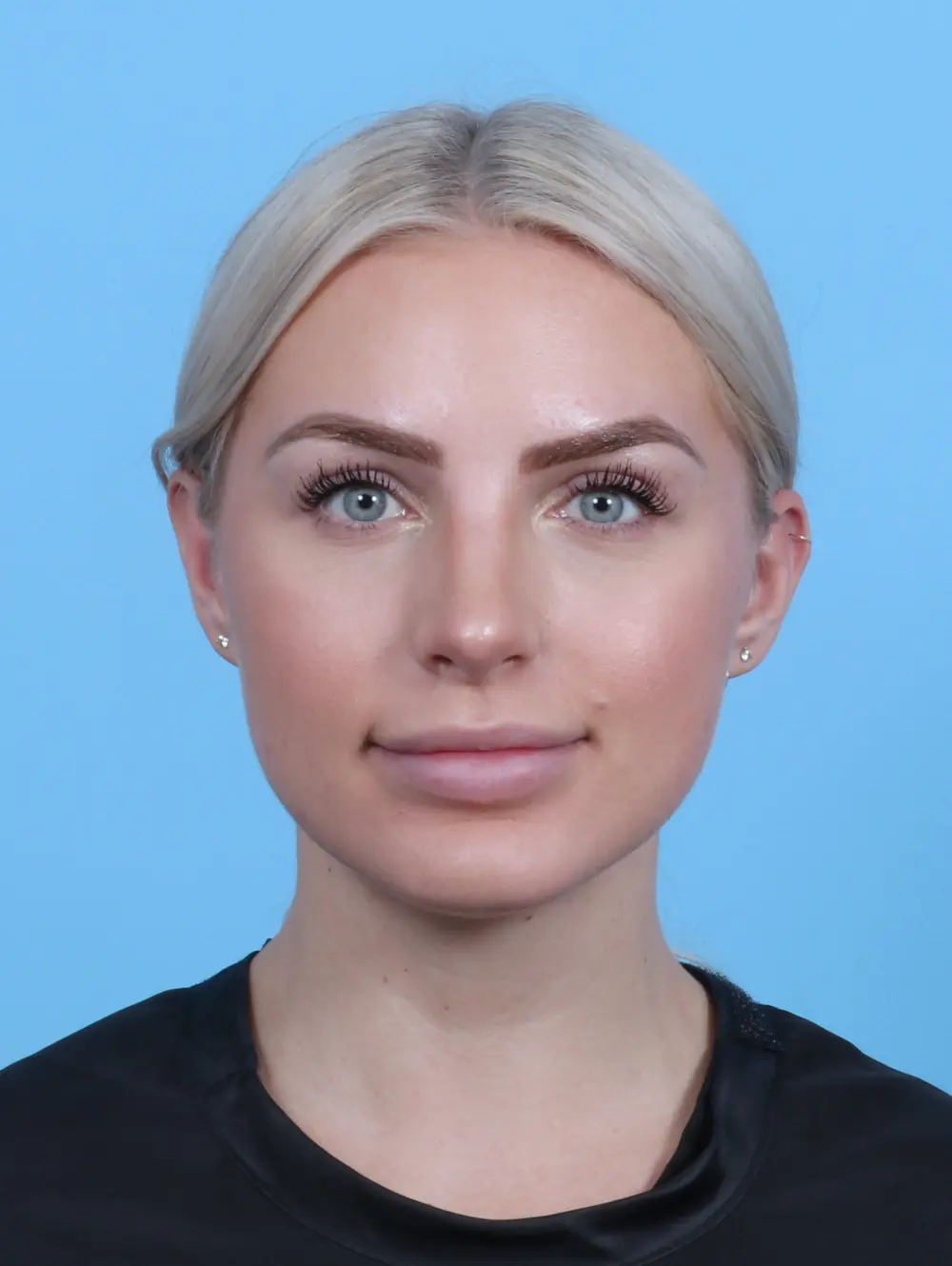 Rhinoplasty Patient Photo - Case 27984 - after view-2