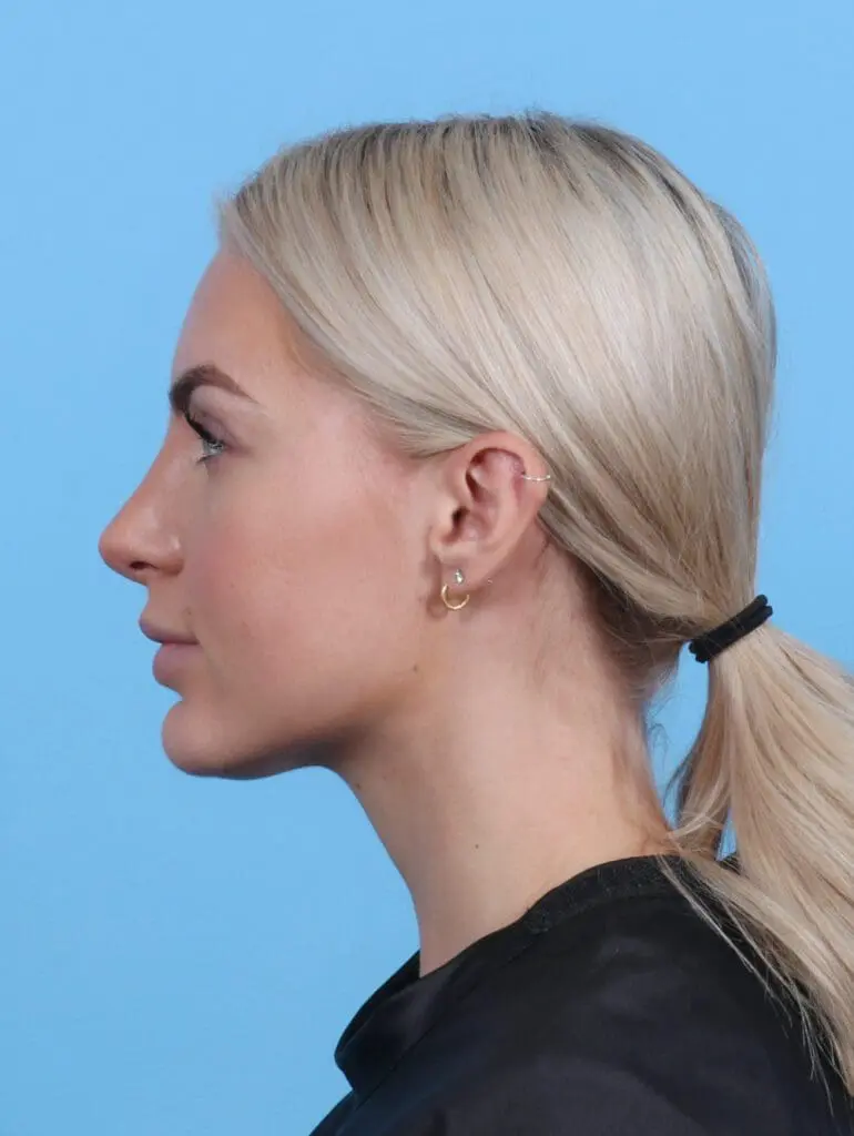 Rhinoplasty - Case 27984 - After