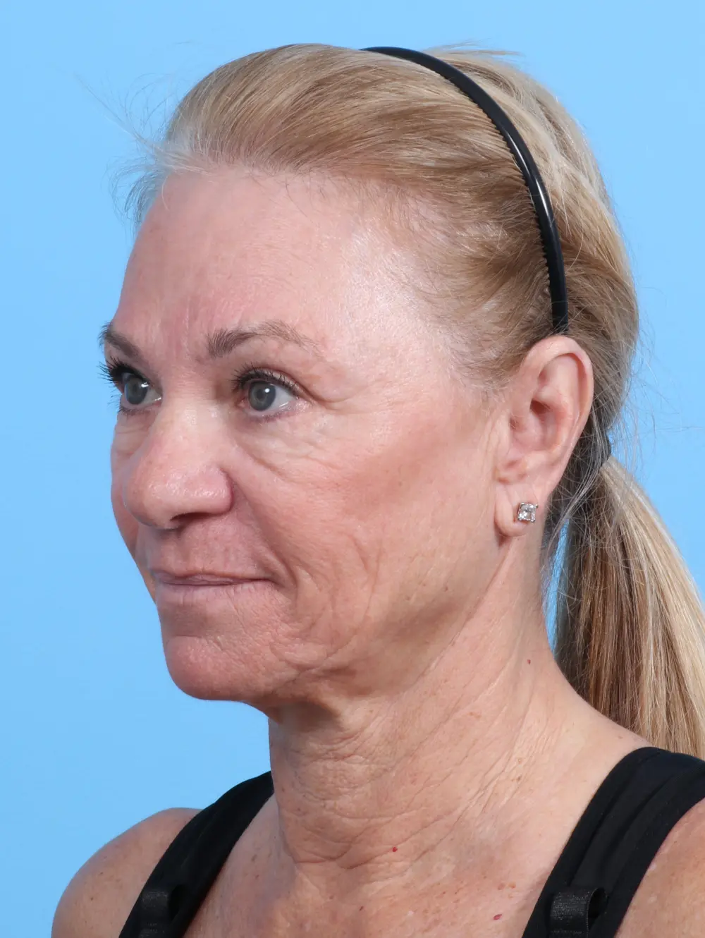Facelift / Neck Lift Patient Photo - Case 27992 - before view-1