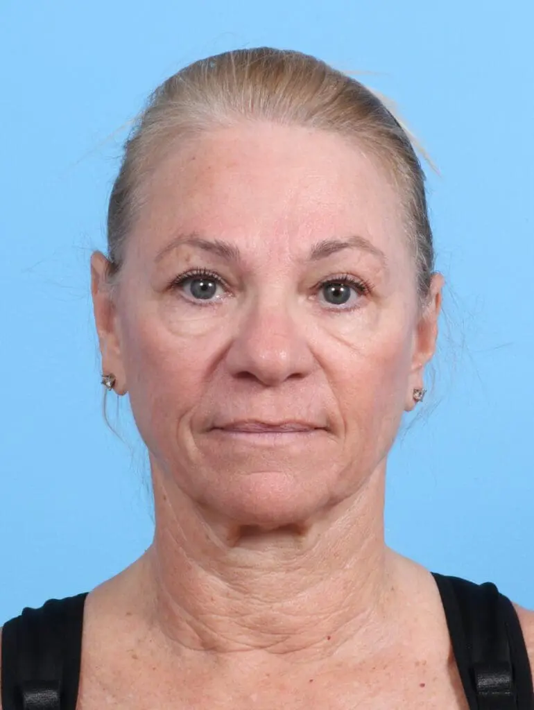 Facelift / Neck Lift - Case 27992 - Before