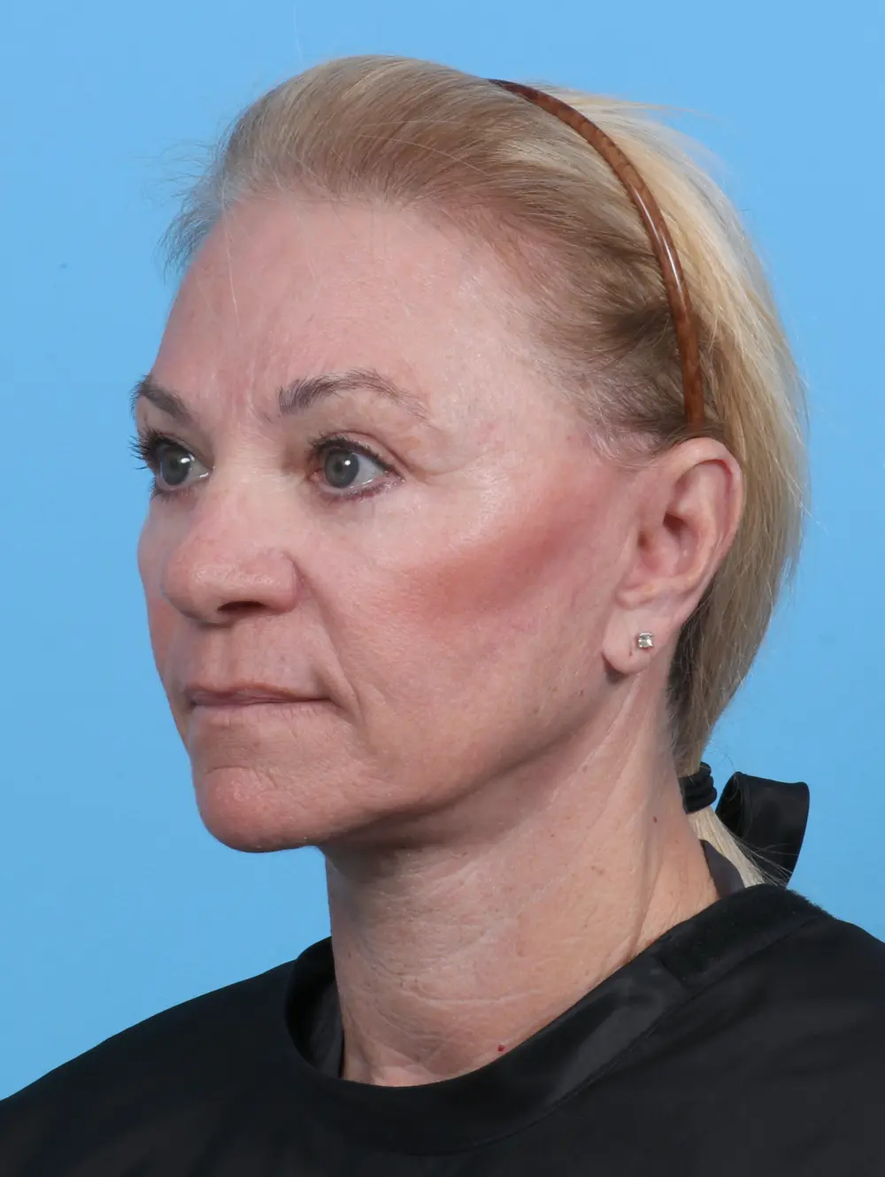 Facelift / Neck Lift Patient Photo - Case 27992 - after view-1