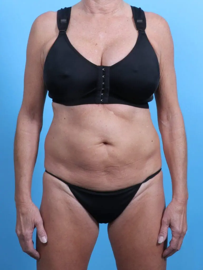 Tummy Tuck - Case 28001 - Before