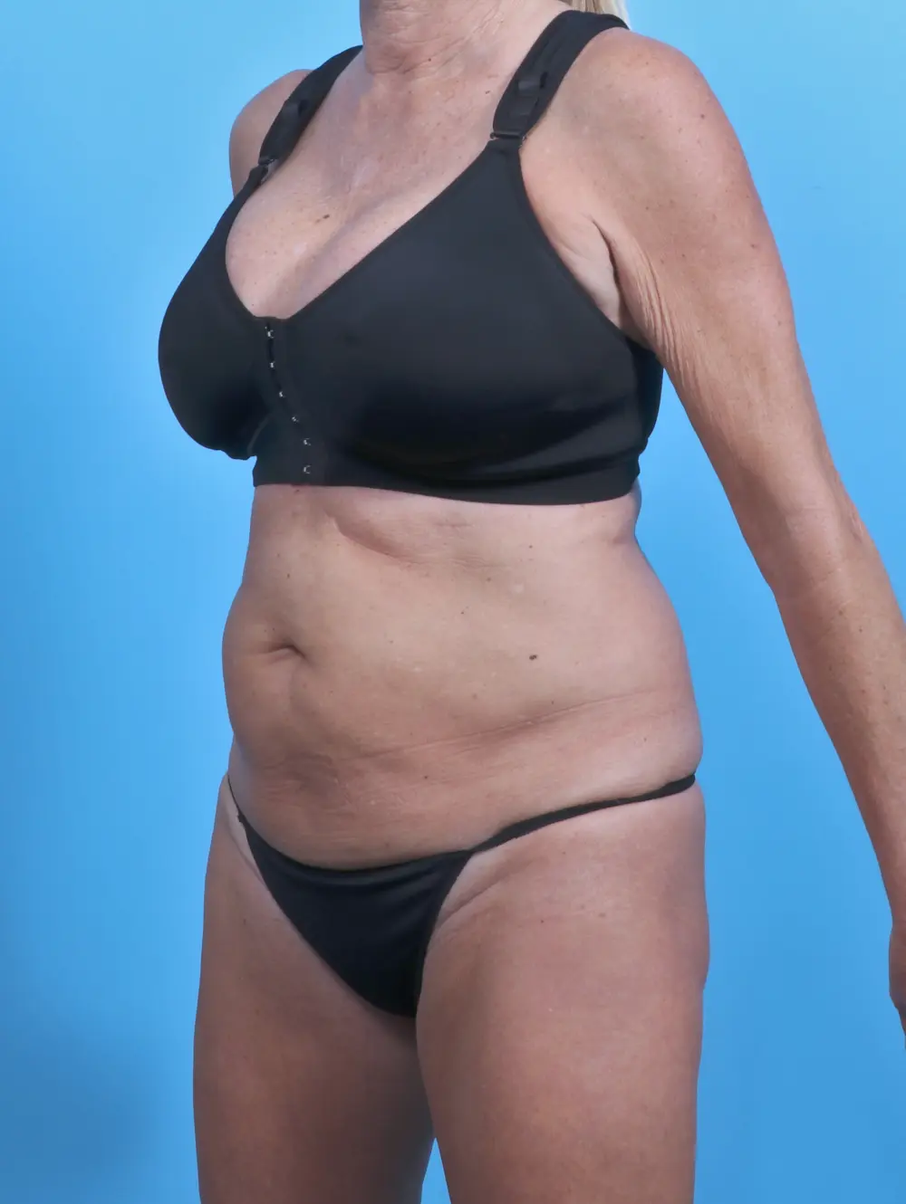 Tummy Tuck Patient Photo - Case 28001 - before view-1