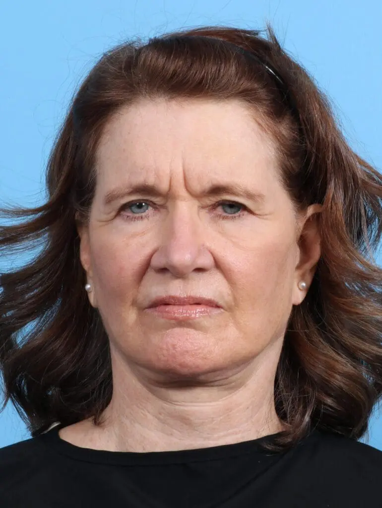 Brow Lift - Case 28019 - Before