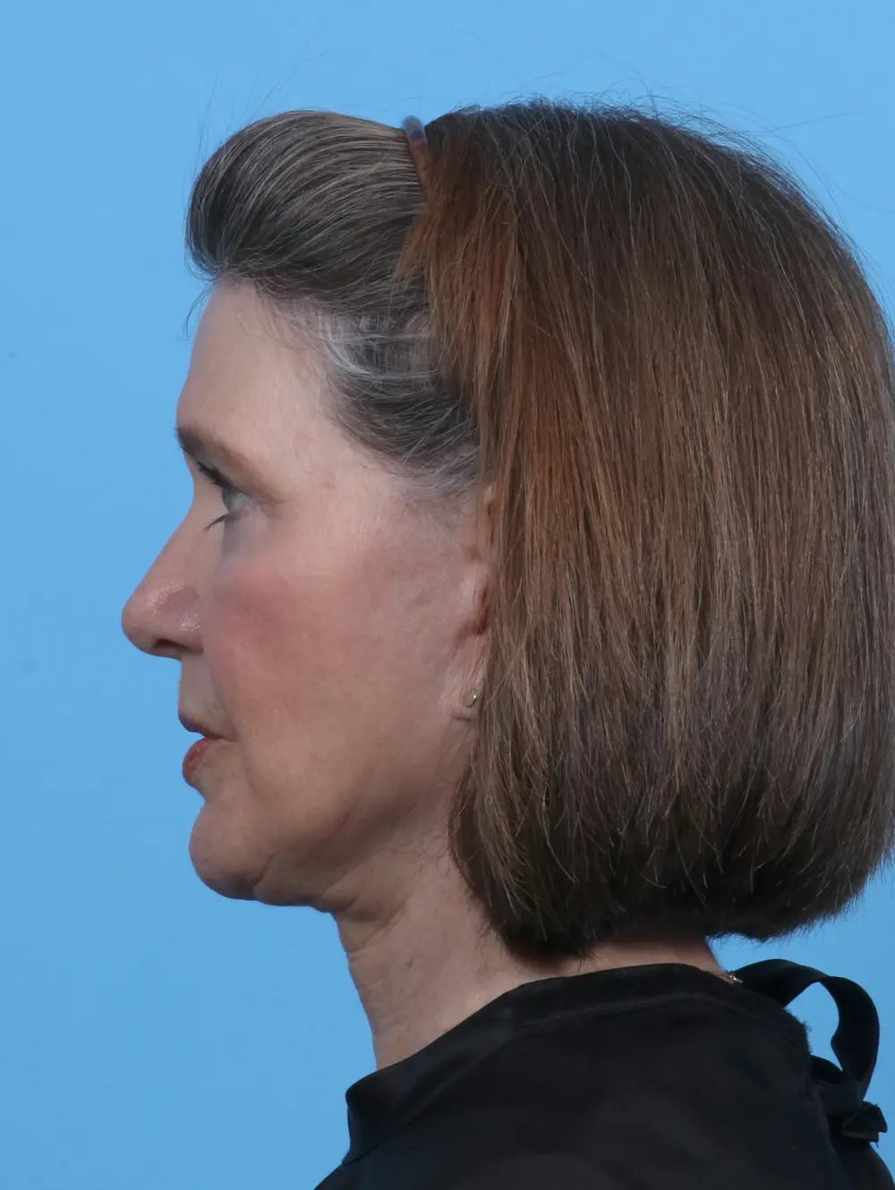 Brow Lift Patient Photo - Case 28019 - after view-2