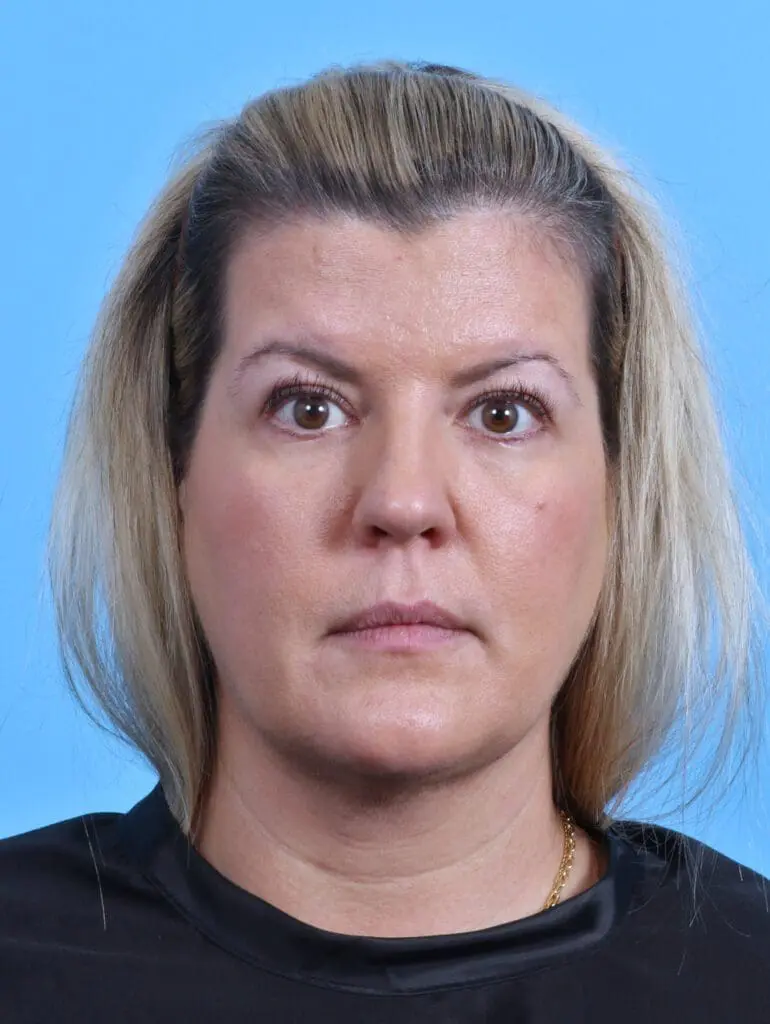 Eyelid Surgery - Case 28075 - Before